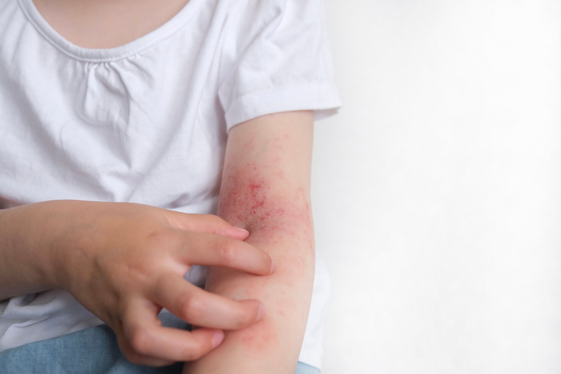 The,Child,Scratches,Atopic,Skin.,Dermatitis,,Diathesis,,Allergy,On,The